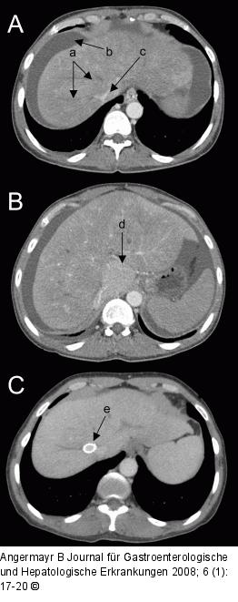 Budd-Chiari-Syndrom
