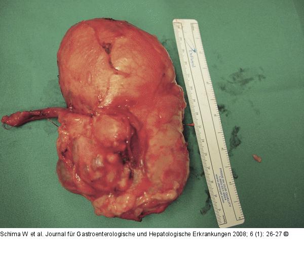 Tumor - Appendix