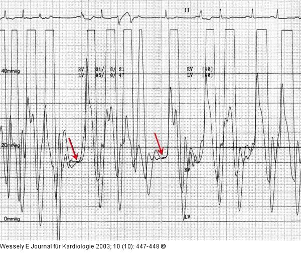 Pericarditis constrictiva