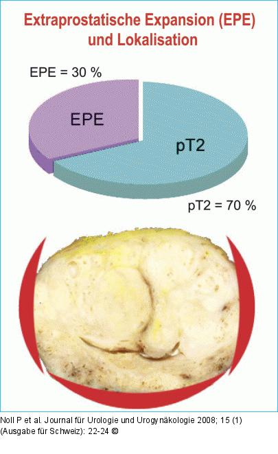 EPE