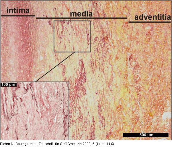Aortenaneurysma