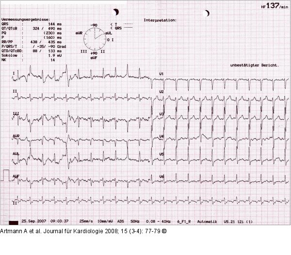 EKG