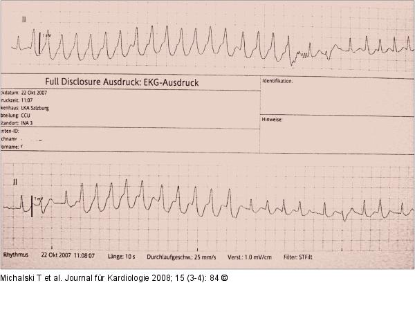EKG