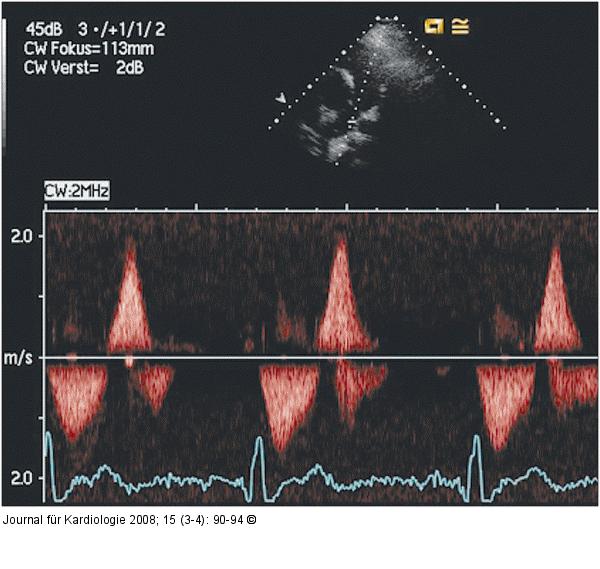 Pulmonalarterie