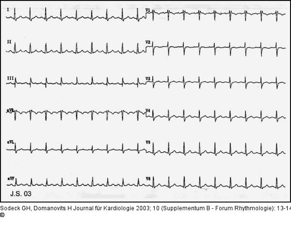 Brugada-Syndrom