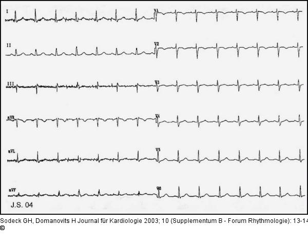Brugada-Syndrom