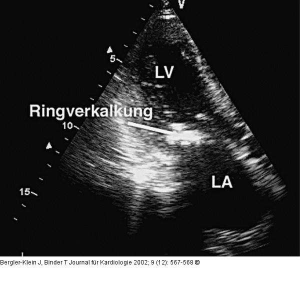 Mitralklappen - Ringverkalkung