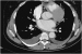 Aktuelles Bild - Abb. 8: Aorta-Dissektionsmembran