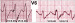 Abb. 8: QRS-Komplex