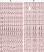 Abb. 12: RSB-Aberration