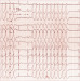 Abb. 18: Ausflusstrakt-Tachykardie