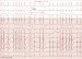 Abb. 20: Tachykardie