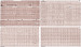 Aktuelles Bild - Abb. 25: Vorhofflimmern