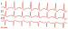 Abb. 1: EKG