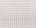Abb. 1: EKG
