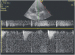 Abb. 11: LVOT-VTI