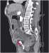 Aktuelles Bild - Abb. 1d: Inguinalhernie