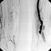 Abb. 1: Aneursyma