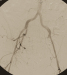 Abb. 1: Morbus embolicus