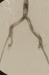 Abb. 8: Morbus embolicus