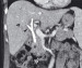 Aktuelles Bild - Abb. 1b: Bilaterale Gallengangstents