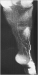 Abb. 2: MR-Lymphographie 