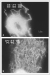 Abb. 4: Lymphdem