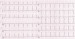 Abb. 1: EKG