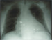 Abb. 9: PA-Rntgen