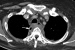 Abb. 1c: Mediastinum