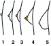 Abb. 1: Gynkomastie