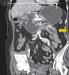 Abb. 5: CT-Cholezystis - Ileus