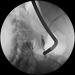 Abb. 3: Ductus choledochus - Mirizzi-Syndrom