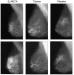 Abb. 1: HRT- Mammogramm
