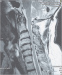 Abb. 1: Spinalkanal
