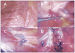 Abb. 1: Endometriose