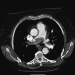 Abb. 1: Pulmonalarterienembolie