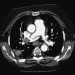 Abb. 2: Thrombuslast - Regredienz
