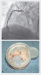 Aktuelles Bild - Abb. 3: TIMI-III-Fluss
