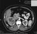 Abb. 1a: Tumor - Niere