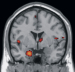 Abb. 2: Alzheimer-Demenz