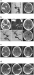 Abb. 1a-d: Aneurysmatische Subarachnoidalblutung