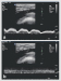 Abb. 4a-b: Vena femoralis communis