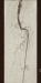 Abb. 10: Arteria femoralis - Verschluss