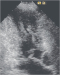 Aktuelles Bild - Abb. 2: Hypertrophe CMP