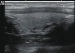 Abb. 1: Schilddrsensonographie