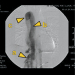 Aktuelles Bild - Abb. 1a-c: Cavographie