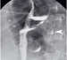 Aktuelles Bild - Abb. 1: Gastro-bronchiale Fistel
