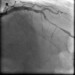 Abb. 11: Direct Stenting