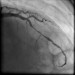 Abb. 12: Direct Stenting